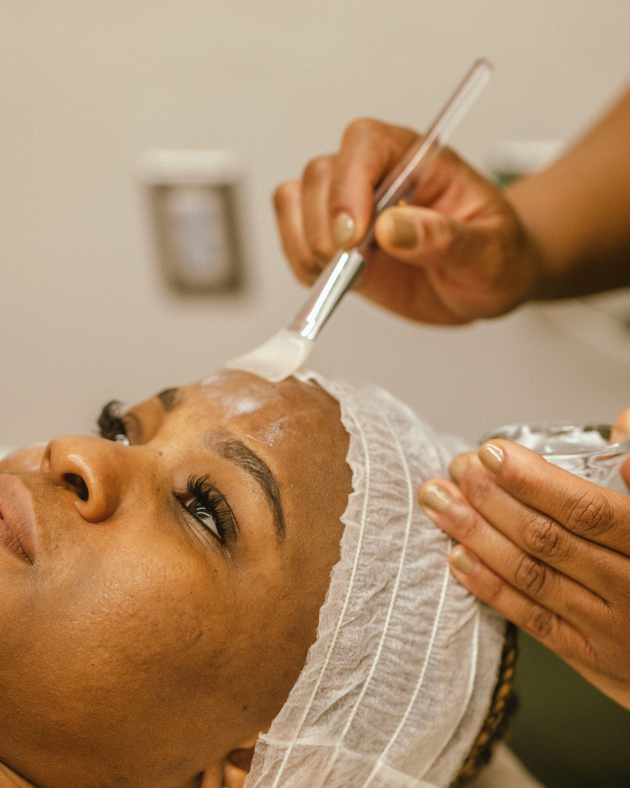 Microneedling treatment at Optimal Wellness Centre